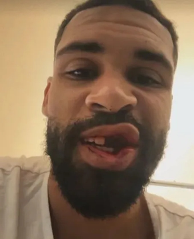 Khuôn mặt biến dạng của Loftus-Cheek 